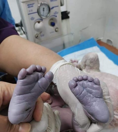 تولد نوزادی با ۲۴ انگشت