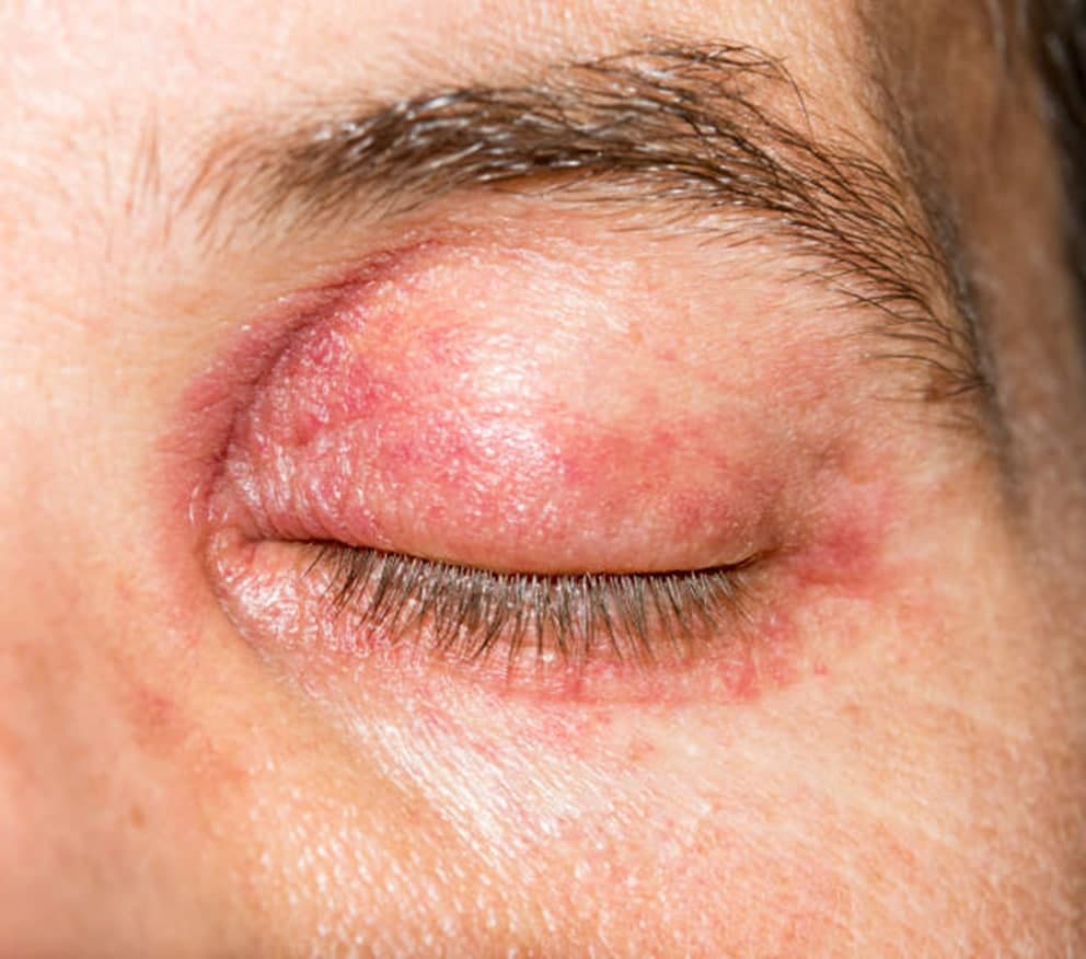 قرمزی اطراف چشم از انواع بیماری های پوستی دور چشم