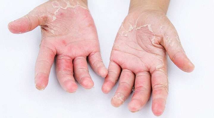 Alergic-Reaction-to-Gloves-حساسیت-1