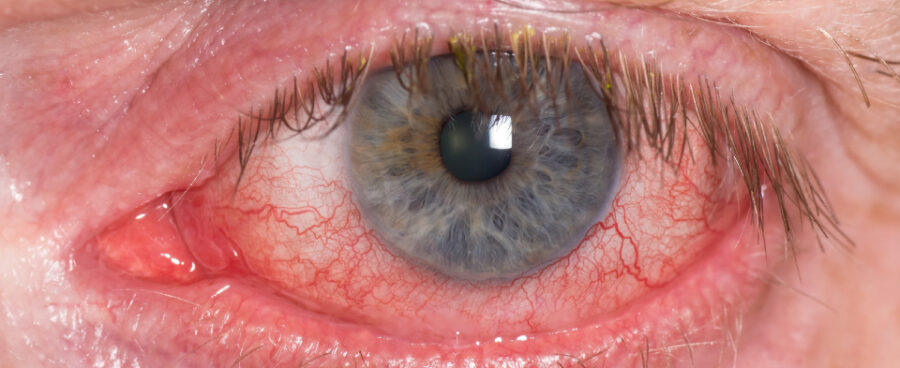 علائم چشمی کلسترول